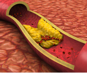 Atherosclerotic plaque is a serious condition - stop it before it starts!